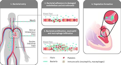 Infective Endocarditis Pathogenesis