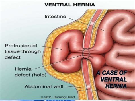 Surgery case presentation on anterior abdominal wall hernia