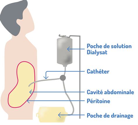 Traitement De Suppléance Par Dialyse Aub Santé