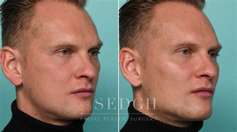 Chin Filler Before And After Photos Sedgh Plastic Surgery