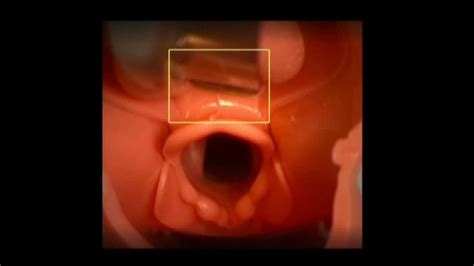 Endotracheal intubation A3chem Multimedia - YouTube