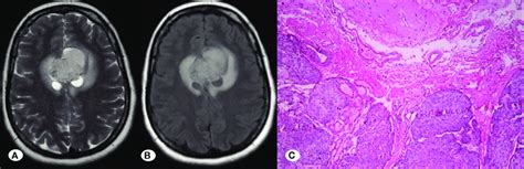 Preoperative Axial T2 Weighted A And Flair B Magnetic Resonance Download Scientific Diagram