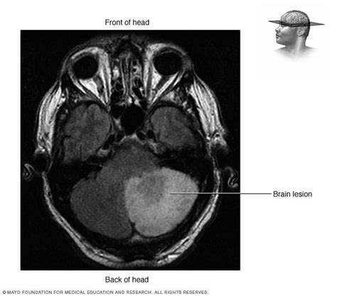 Brain Lesion On Mri Mayo Clinic