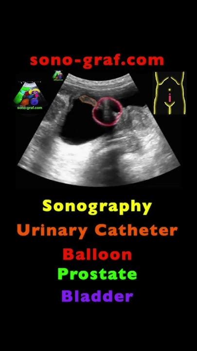 sonography urinary catheter youtube