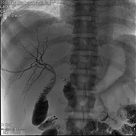 Final Post Operative Cholangiogram With Normal Intrahepatic Ducts