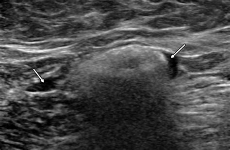 Multimodality Imaging Based Evaluation Of Single Lumen Silicone Breast Implants For Rupture