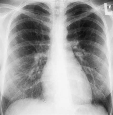 Atrial Septal Defect Asd Congenital Heart Disease In Adults