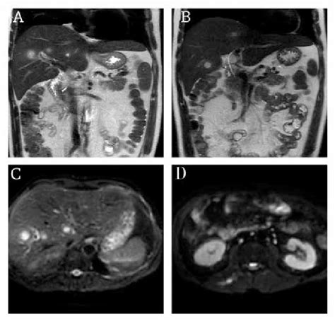 A B C Multiple Liver Abscesses Are Seen D Single Focus Of Abscessin