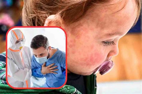 Picco Di Morbillo In Italia Come Individuare Subito I Sintomi Per