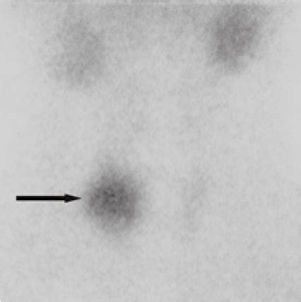 Tc 99m Pertechnetate Thyroid Scan Shows A Hot Nodule In The Right