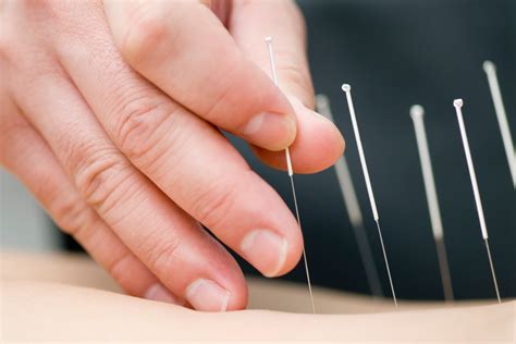 Acupuncture For Sciatica Everything You Need To Know Dorsal