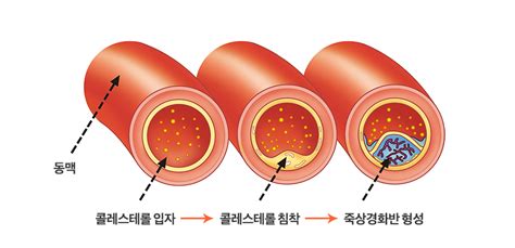 고지혈증이상지질혈증