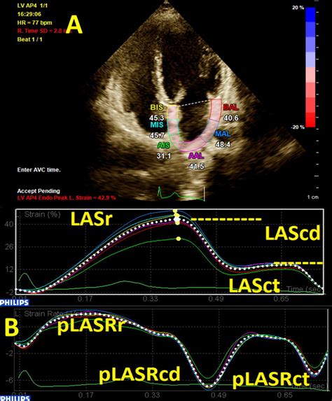 Two Dimensional Speckle Tracking Echocardiography Of The Left Atrium In