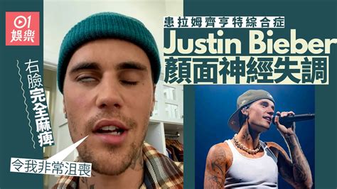 Justin Bieber驚爆面癱 罹患罕見疾病臉歪嘴斜巡迴個唱急煞停