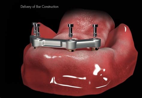 Lower implant bar denture 5 - Woods Dental