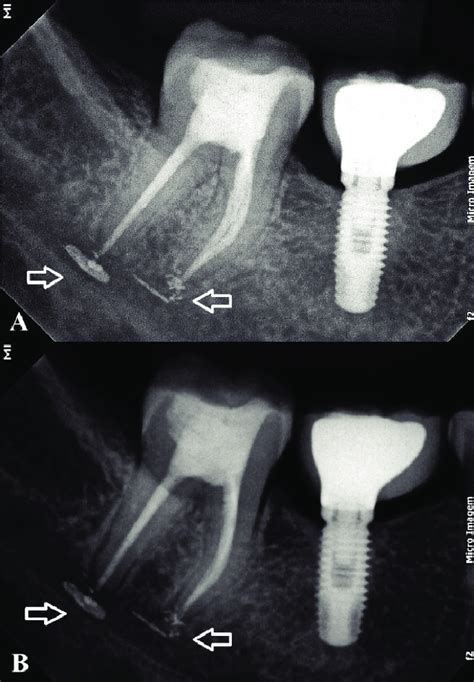 Periapical Radiographs Of Postoperative Control Of The Right First And