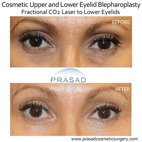 Laser Treatment For Dark Circles Under Eyes Dr Prasad Blog