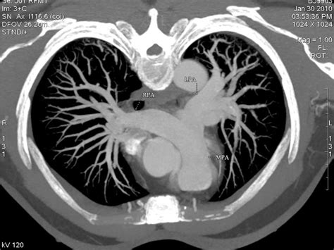 Ct Pulmonary Angiogram