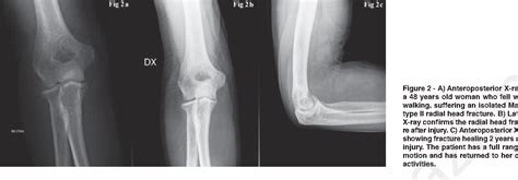 Figure From Nonsurgical Treatment Of Mason Type Ii Radial Head