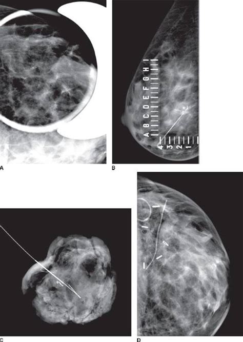 Ductal Carcinoma In Situ Clinical Scenarios In Surgery Decision