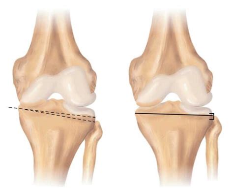 Knee Osteotomy High Tibial Tibial Tubercle Distal Femoral