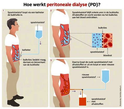 Peritoneaal dialyse