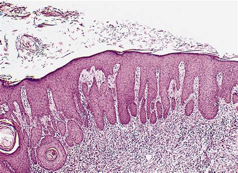 Pseudoepitheliomatous Hyperplasia Libre Pathology