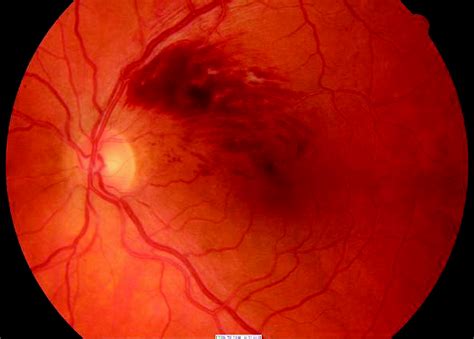 Flame Shaped Hemorrhages