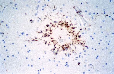 Plasmodium Falciparum Malaria Cerebral