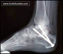 Subtalar joint arthrodesis - Dr Steve Edwards