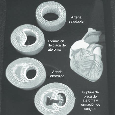 Representación esquemática del ateroma hasta que se presenta la rotura ...