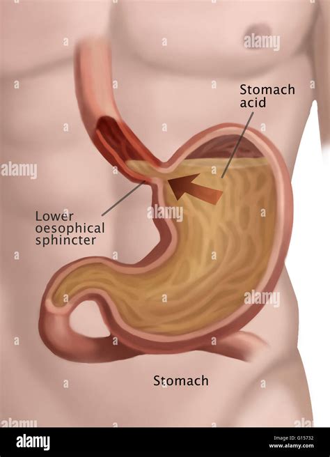 Una Ilustración Médica Mostrando El Reflujo De ácido Del Estómago