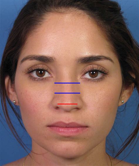 Finesse Ethnic Female Rhinoplasty Surgery Dr Hilinski