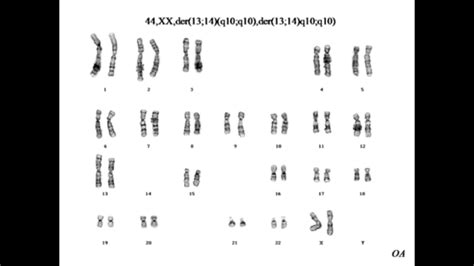 evolution - Can two humans with 44 chromosomes produce viable offspring ...