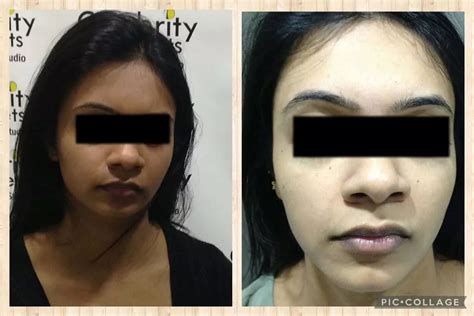 Skin Whitening Tretments Before And After Flash Sales