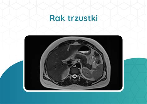 Rak Trzustki Pp Diagnostyka