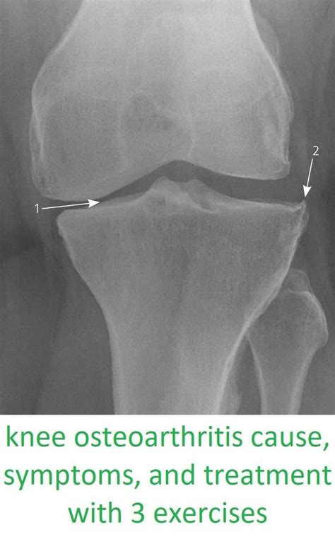 Knee Osteoarthritis Symptoms And Treatment With Exercises