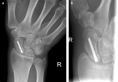 Fractures Of The Scaphoid The Bmj