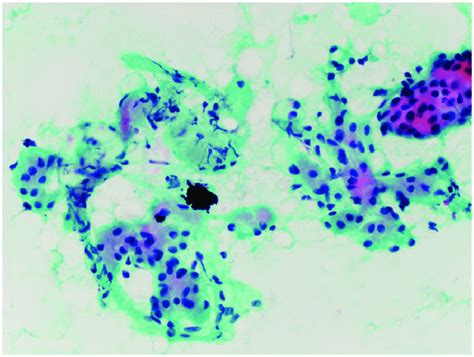 Photomicrograph Showing Clusters Of Oncocytic Epithelium With Download Scientific Diagram