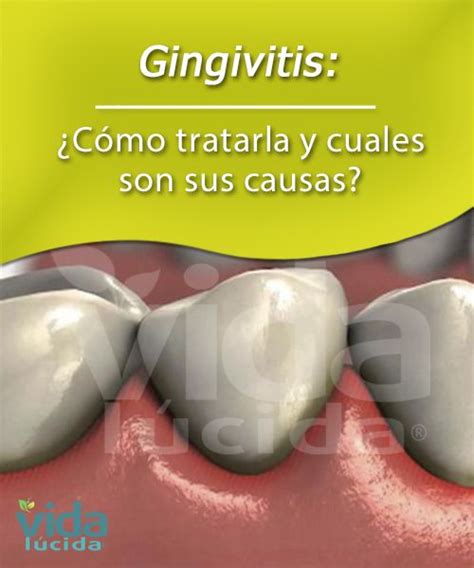 Gingivitis Cómo tratarla y cuales son sus causas Tips de salud