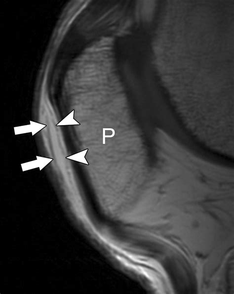 The Prepatellar Bursa Cadaveric Investigation Of Regional Anatomy With