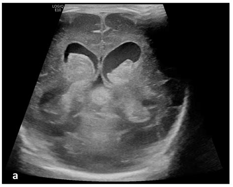 Hydrocephalus Ultrasound