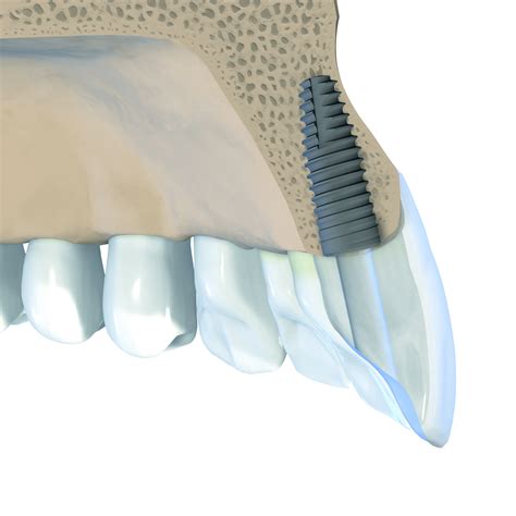 Straumann Introduces A Tapered Implant For Immediate Placement And