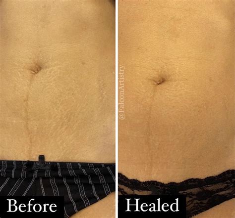 Permanent Makeup Stretch Marks Saubhaya Makeup