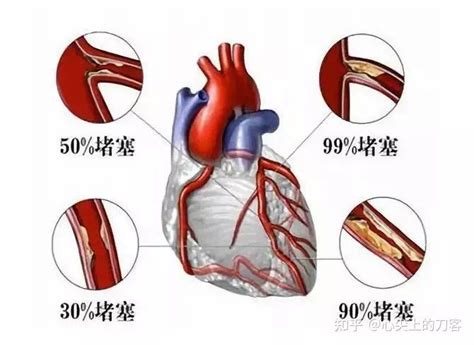 冠心病标准预防治疗 知乎