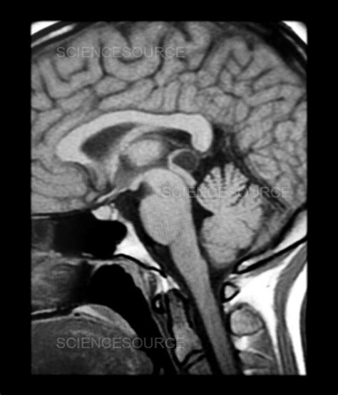 Pineal Gland Mri