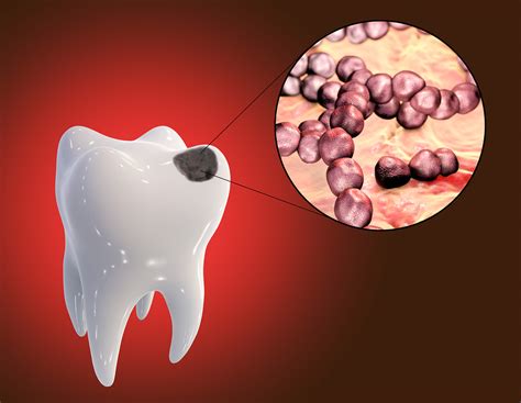 Streptococcus Mutans Caries