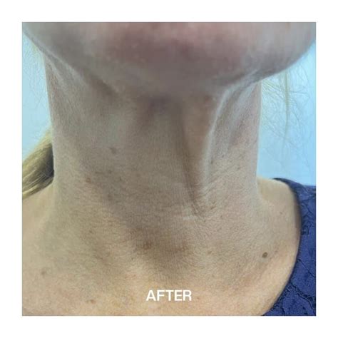 Non Surgical Neck Lift Liverpool Non Surgical Neck Lift