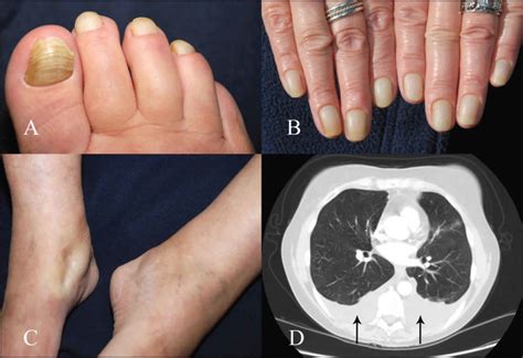 Yellow Nail Syndrome Causes Symptoms Diagnosis And Treatment