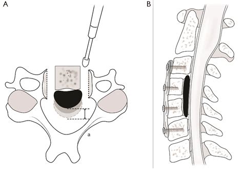 Figure 1 From A Novel Anterior Decompression Technique For Kyphosis